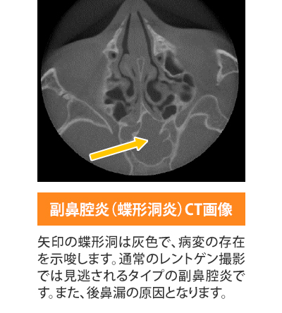 後鼻漏 大阪市福島区の耳鼻科 耳鼻咽喉科長谷川クリニック